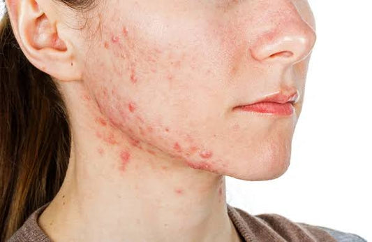 Understanding Acne: Causes and How to Prevent It