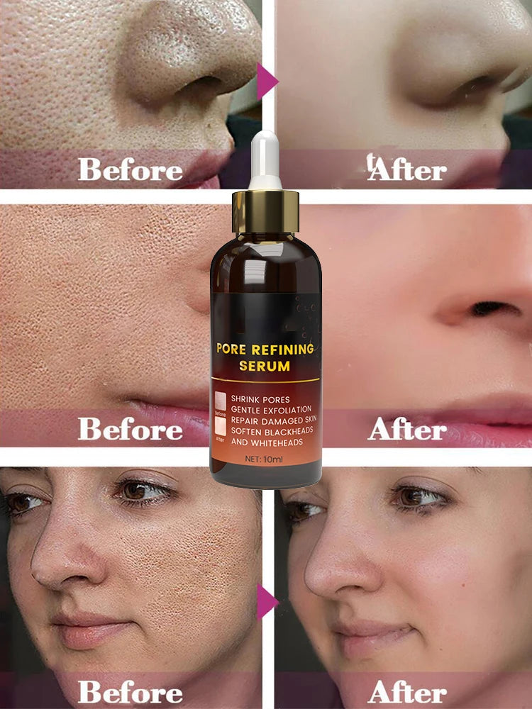 Acne Treatment Anti Aging Serum. - Maison Novaire #