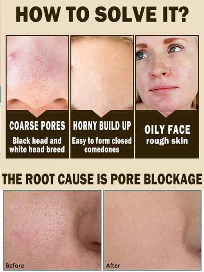 Acne Treatment Anti Aging Serum. - Maison Novaire #