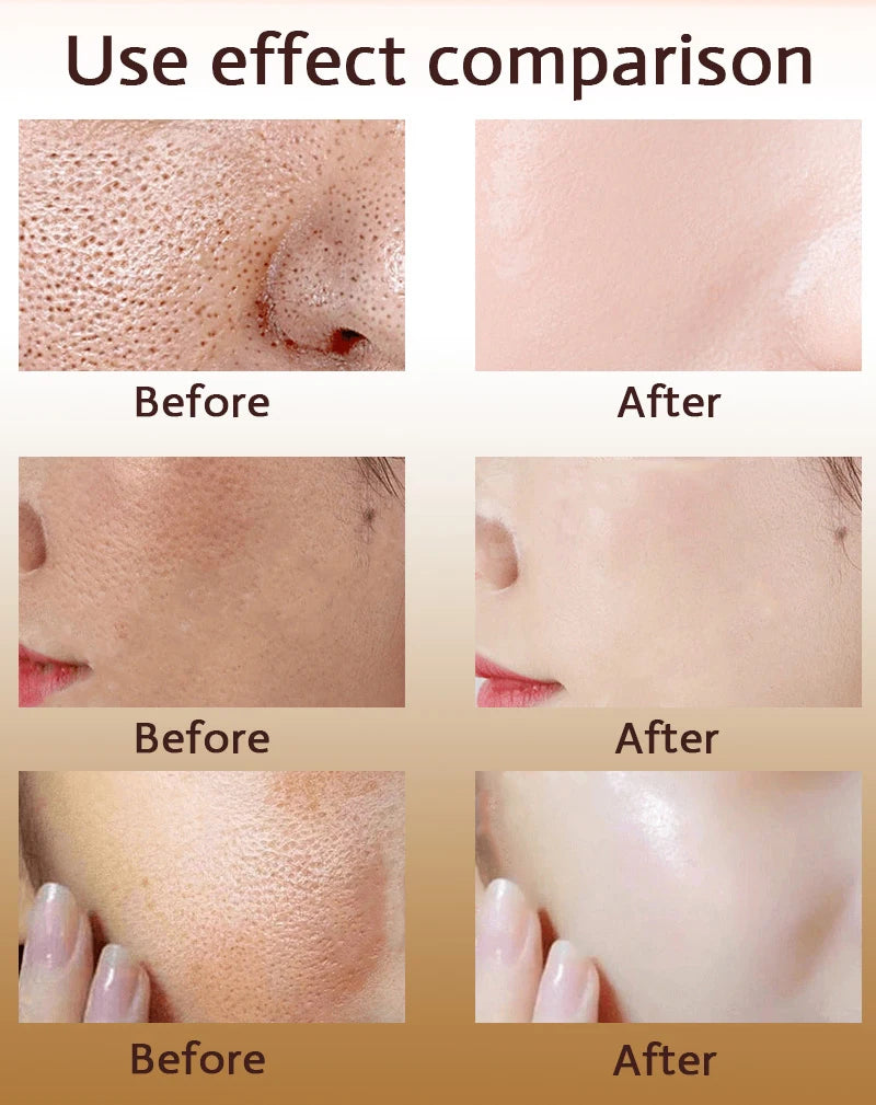Acne Treatment Anti Aging Serum. - Maison Novaire #