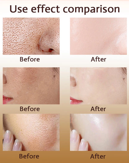 Acne Treatment Anti Aging Serum. - Maison Novaire #