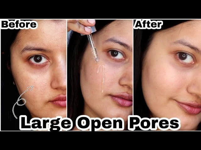 Acne Treatment Anti Aging Serum. - Maison Novaire #