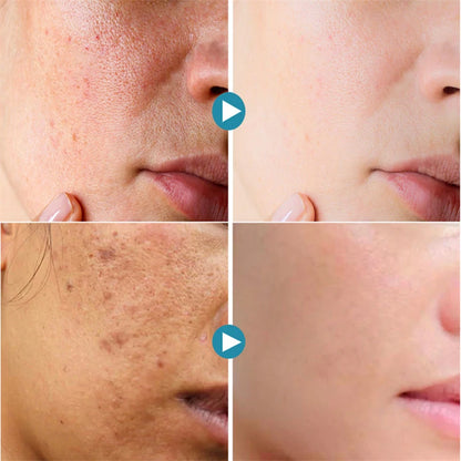 Acne Treatment Anti Aging Serum. - Maison Novaire #