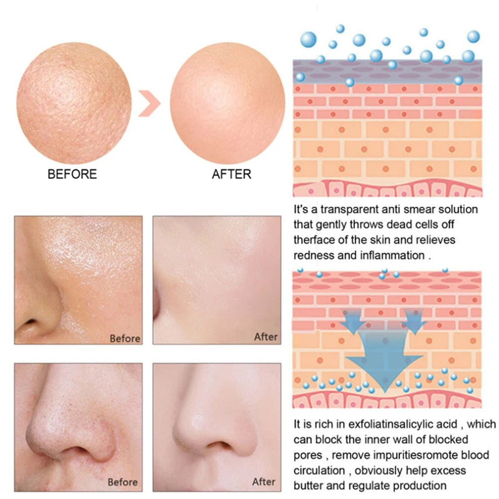 Acne Treatment Anti Aging Serum. - Maison Novaire #