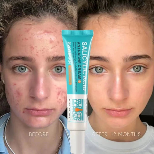 Herbal Acne Removal Face Cream. - Maison Novaire