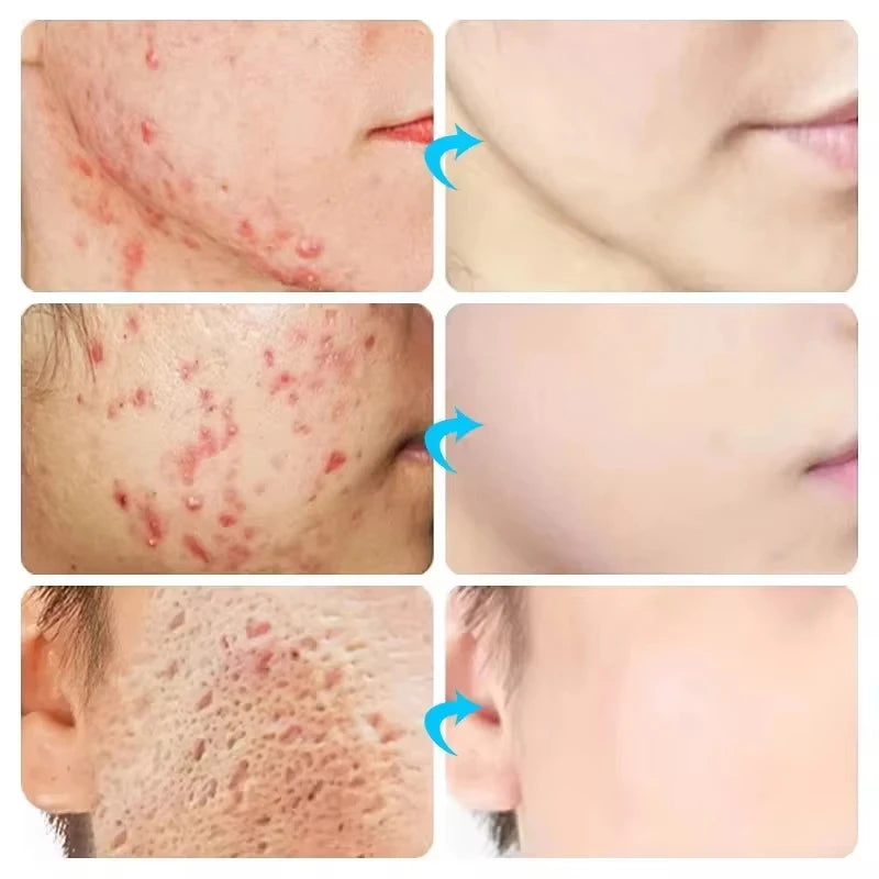 Herbal Acne Removal Face Cream. - Maison Novaire #