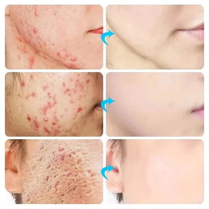 Herbal Acne Removal Face Cream. - Maison Novaire #