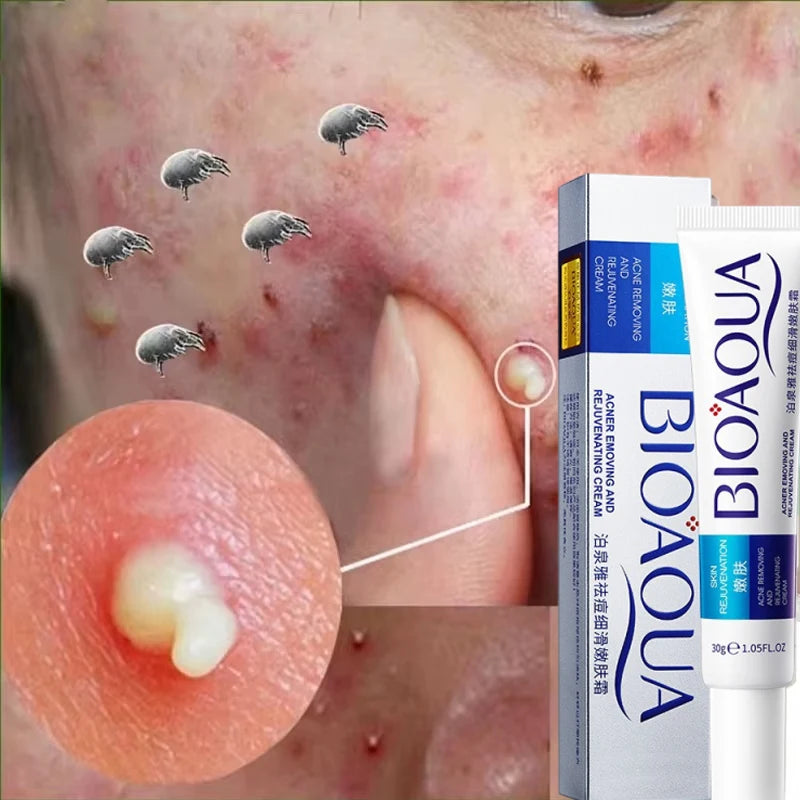 Herbal Acne Removal Face Cream. - Maison Novaire #