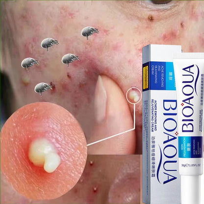 Herbal Acne Removal Face Cream. - Maison Novaire #