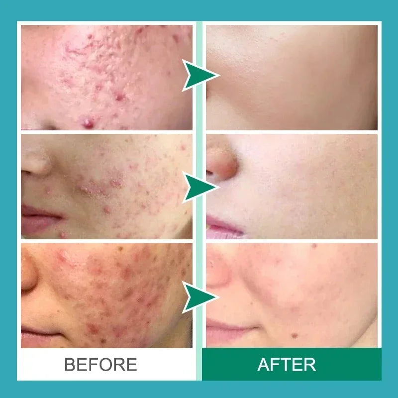 Herbal Acne Removal Face Cream. - Maison Novaire #
