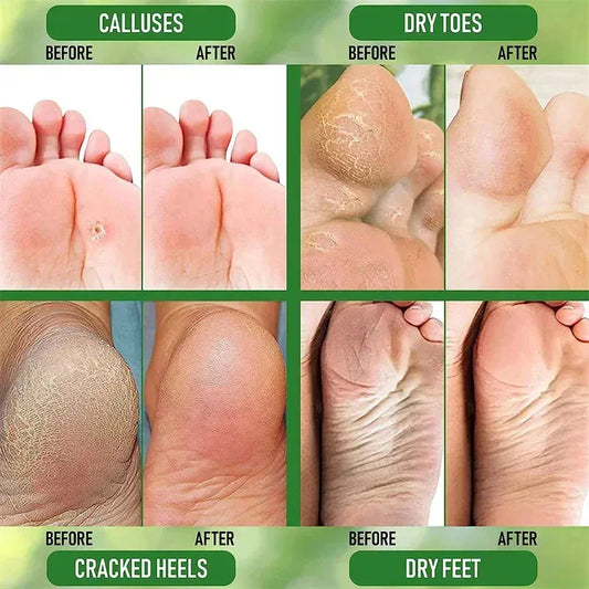 Herbal Anti Crack Foot Heel Cracking Repair Cream. - Maison Novaire