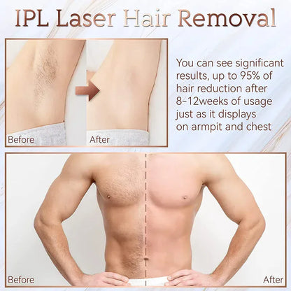 Painless Electric Epilator Laser Hair Removal. - Maison Novaire #
