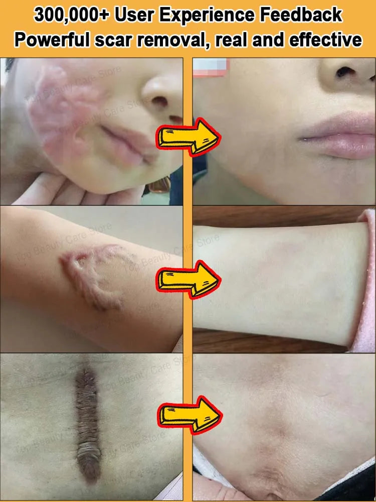 Scar Keloid Laser Removal