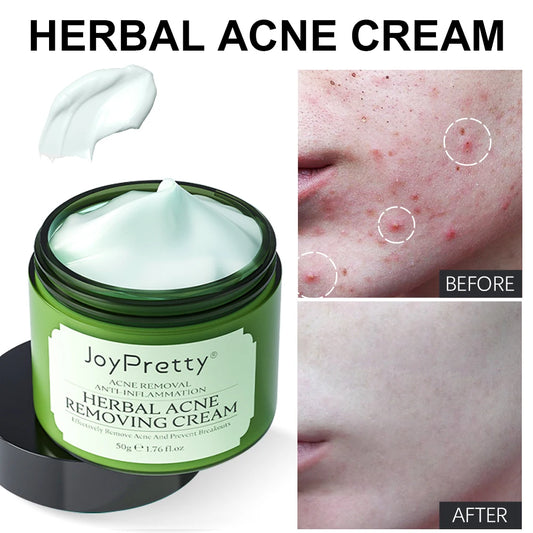 Herbal Acne Face Cream Pimple and Marks Removal Oil.