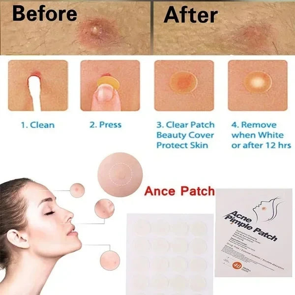 Facial Patches for Treatment of Scar,Acne and Blackheads.