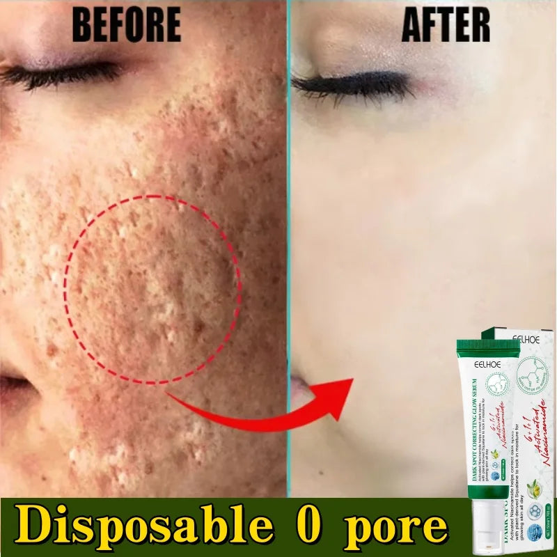 Acne Removal Cream for Men and Women