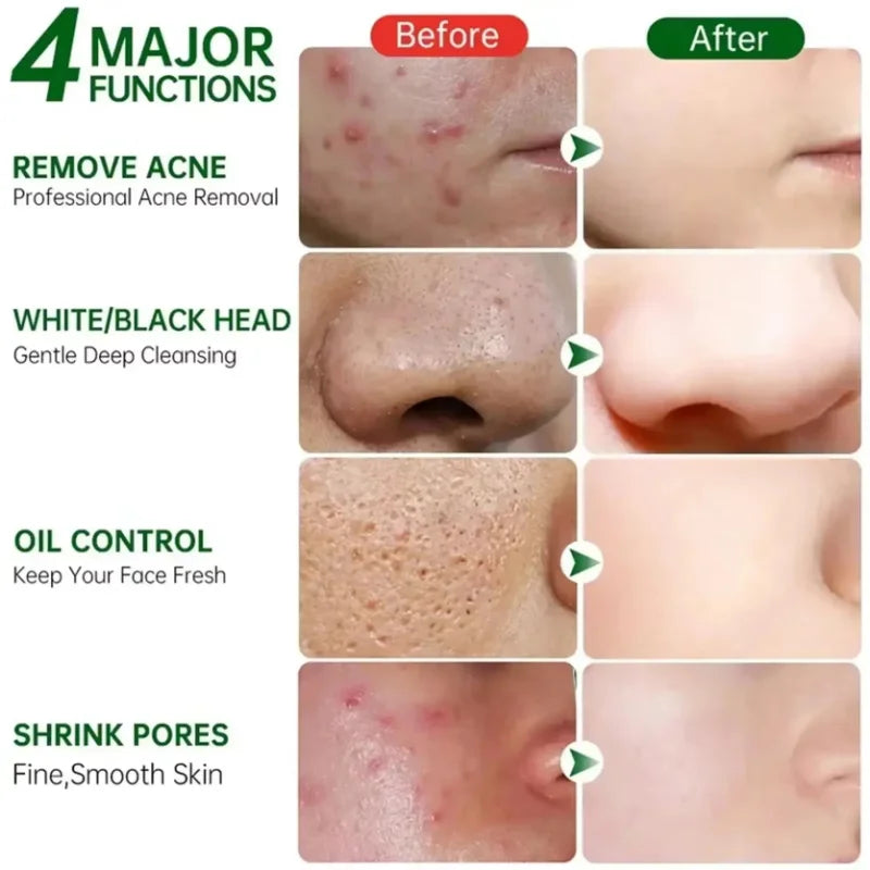 Acne Removal Cream for Men and Women