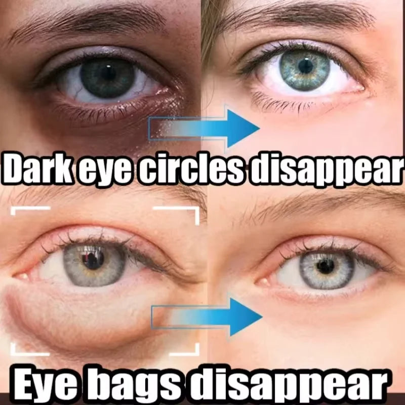 Eye Bag and Dark Circle Removal