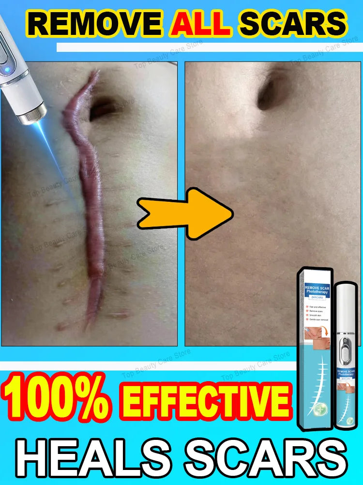 Scar Keloid Laser Removal