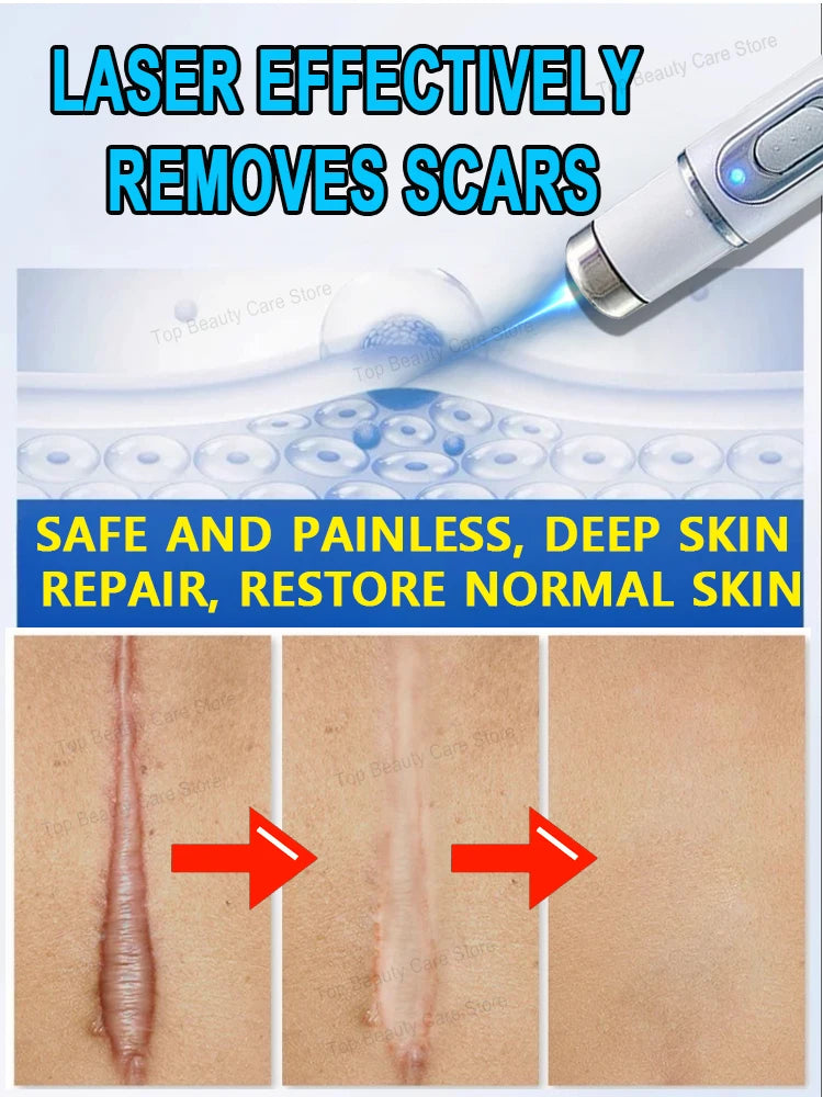 Scar Keloid Laser Removal