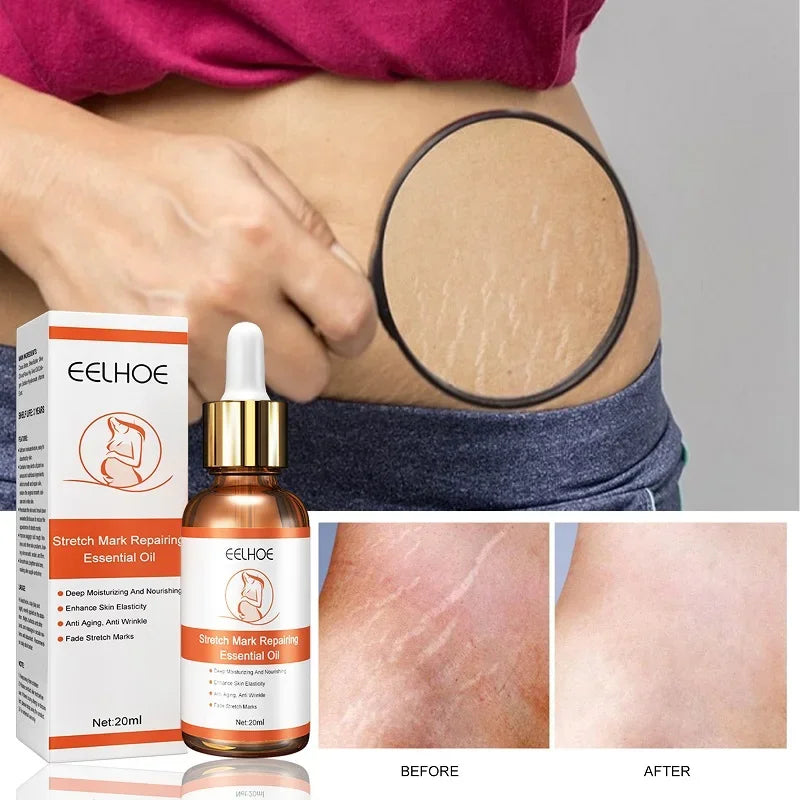 Pregnancy Stretch Mark and Wrinkle Treatment.