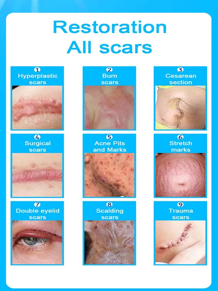 Scar Keloid Laser Removal