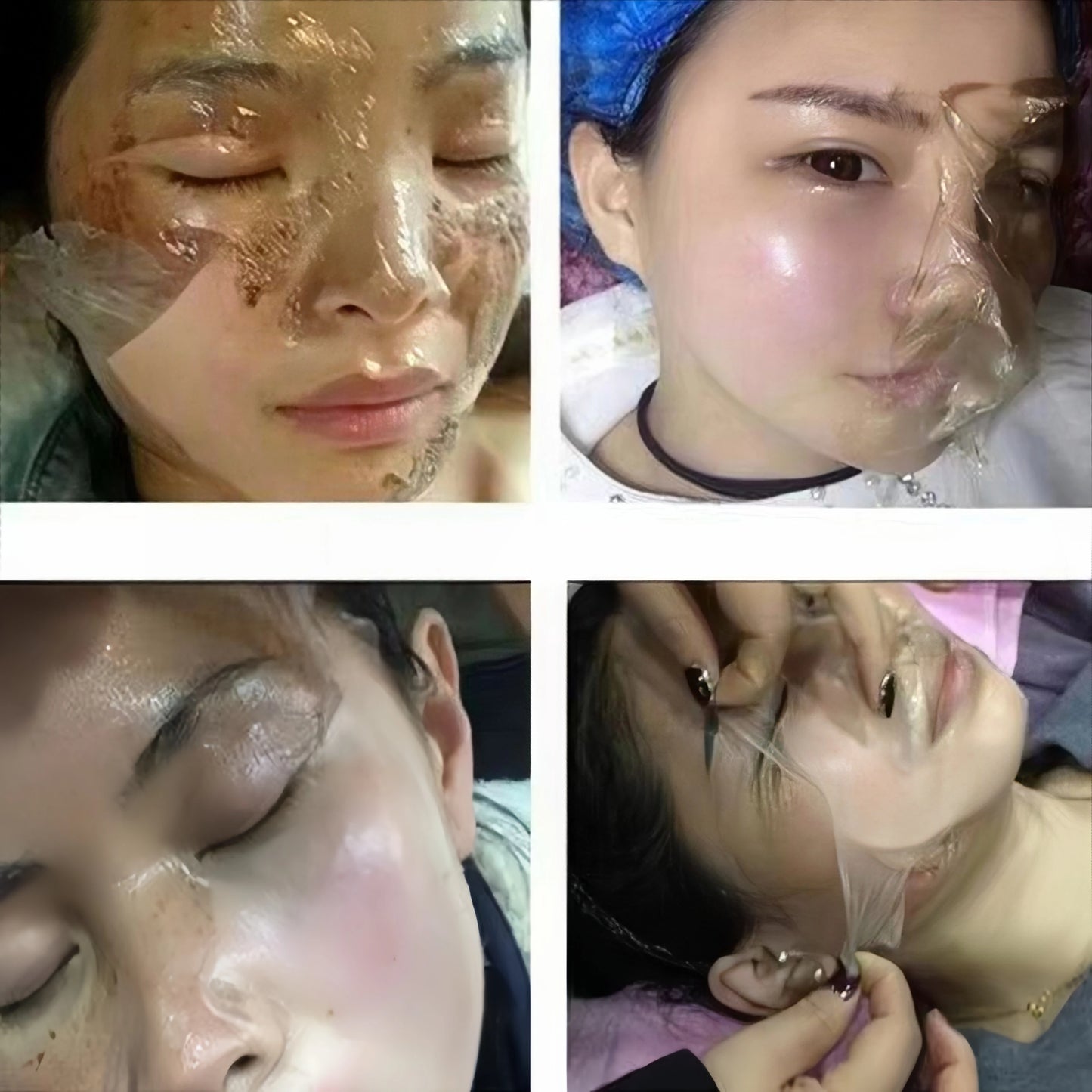 Peel off Mask for Acne and Scars