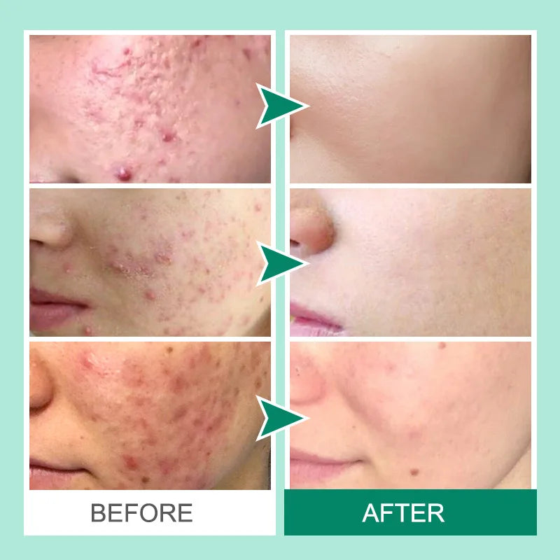 Acne and Blackhead Treatment