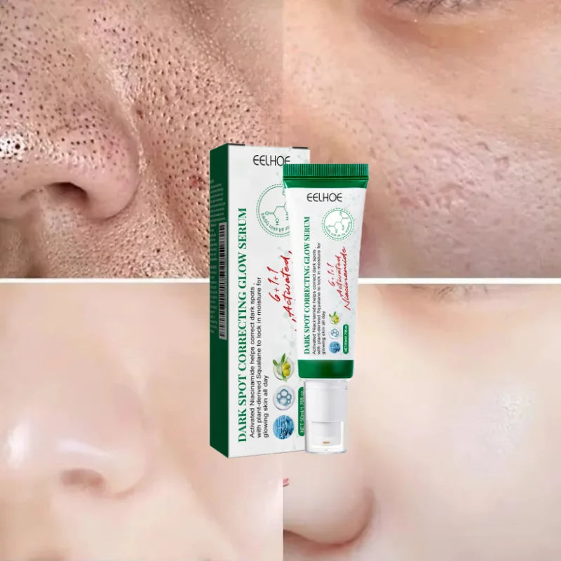 Acne Removal Cream for Men and Women