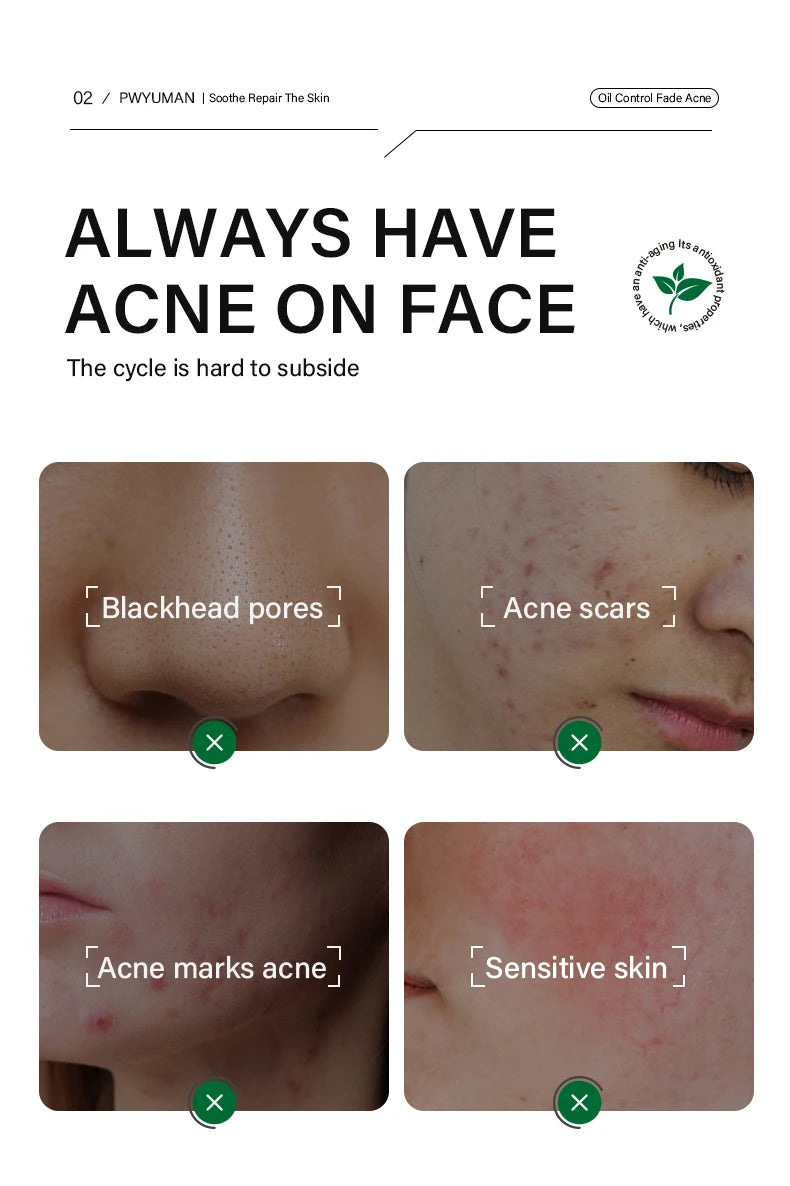 Acne and Blackhead Treatment