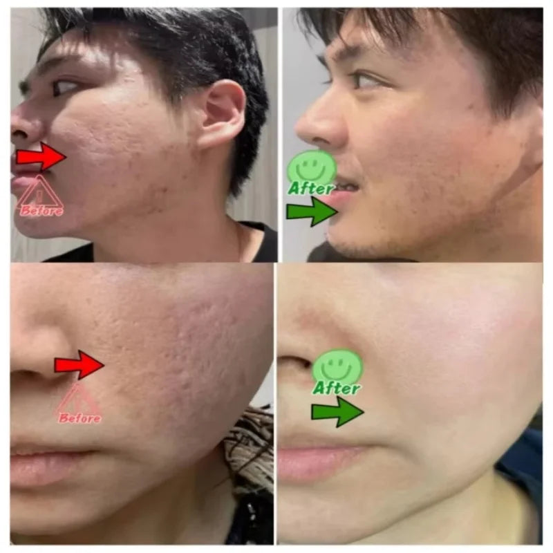 Acne Removal Cream for Men and Women