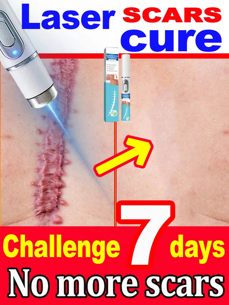 Scar Keloid Laser Removal