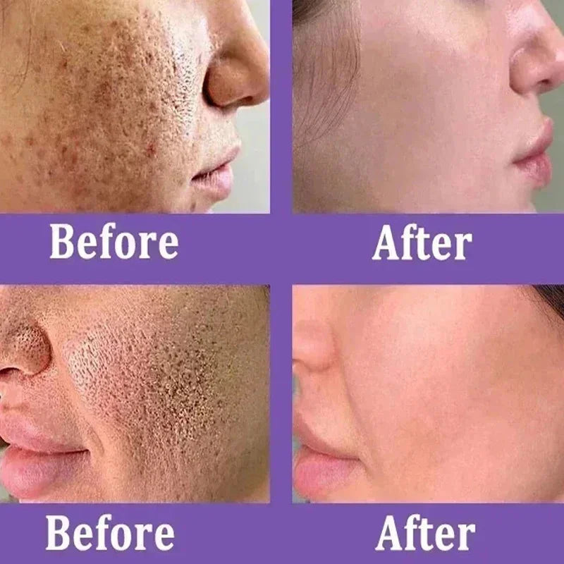 Acne Removal Cream for Men and Women