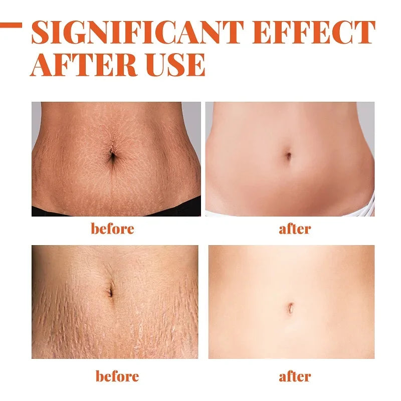 Pregnancy Stretch Mark and Wrinkle Treatment.