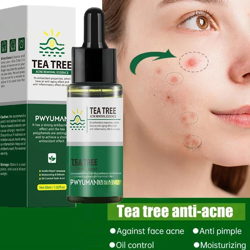 Acne and Blackhead Treatment