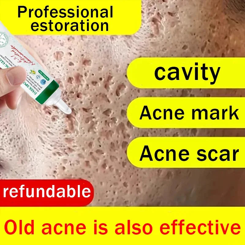 Acne Removal Cream for Men and Women