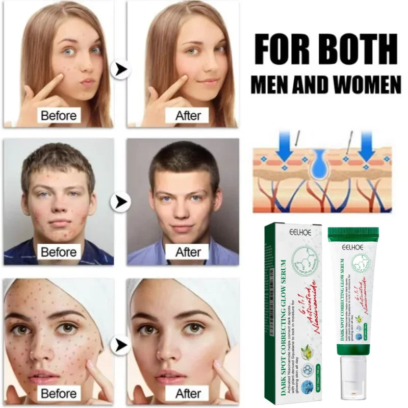 Acne Removal Cream for Men and Women